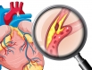 Cảnh báo 6 tác nhân gây hại dến tim mạch mà mọi người cần dặc biệt lưu ý